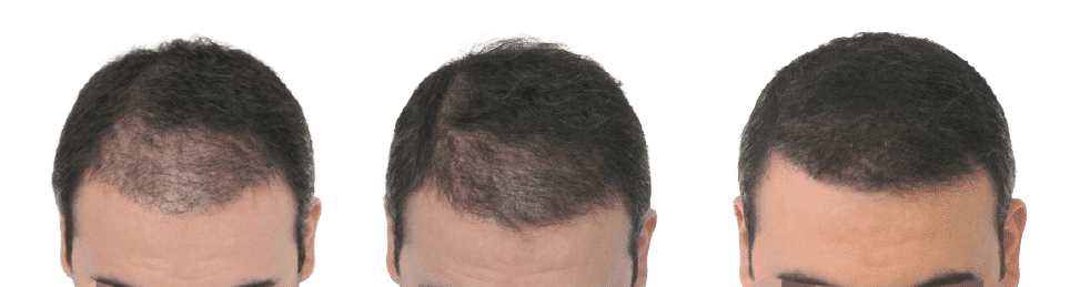 צמיחת השיער לאחר ההשתלה