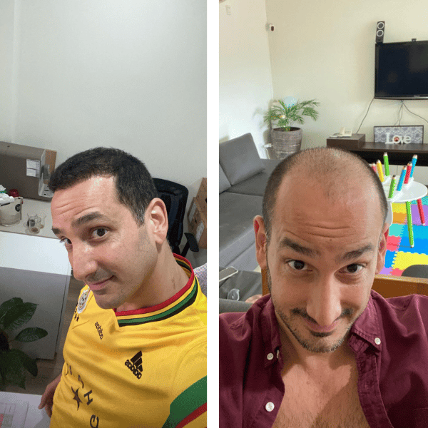 לפני ואחרי של צבי טכניקת השתלת שיער DHI