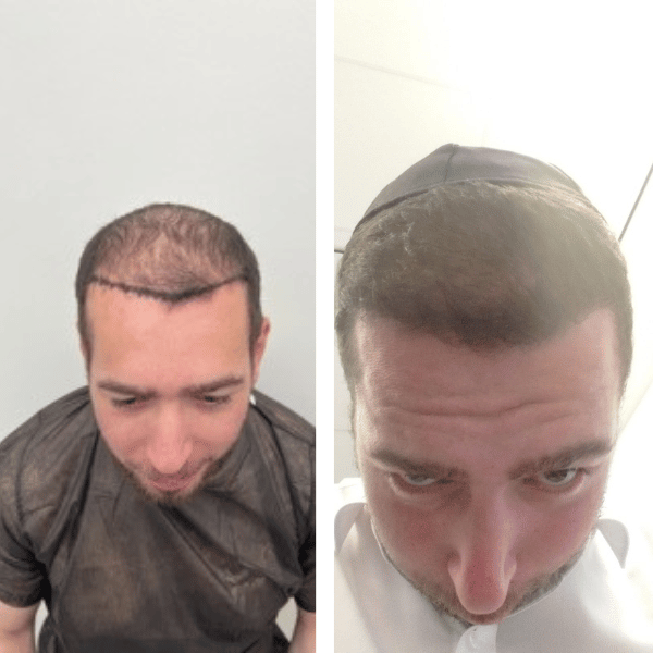 השתלת שיער בטורקיה לפני ואחרי של ישראל
